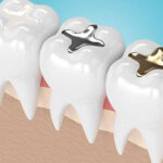 restoration-fillings