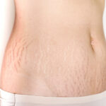 Stretch-Mark-Reduction